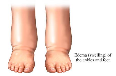Edema - Swelling of Ankle