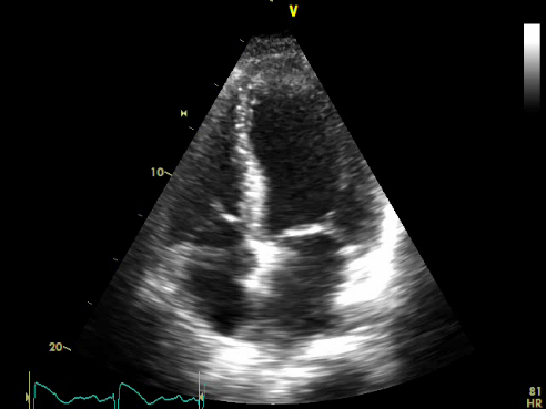 Treatment for Advance Heart Failure