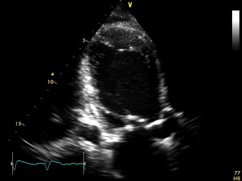 Advance Heart Failure Treatment