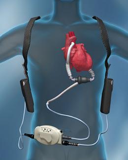 Lvad Singapore - Apex Heart Clinic