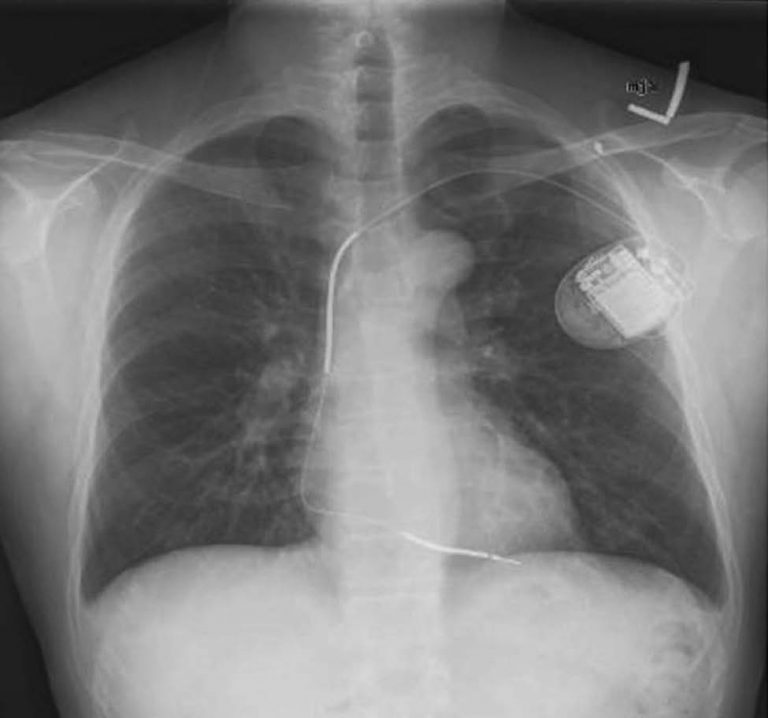 Pacemaker Implantation - Apex Heart Clinic